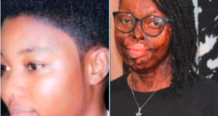 When Martha Karikari Asiamah, the acid victim felt a harsh substance on her face and body four years ago, she screamed in pain. 