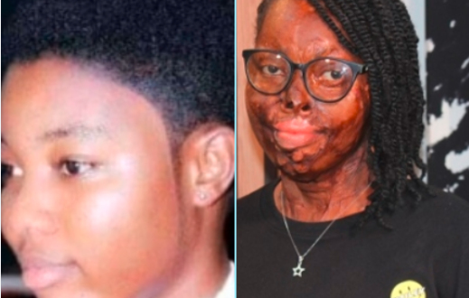 When Martha Karikari Asiamah, the acid victim felt a harsh substance on her face and body four years ago, she screamed in pain. 