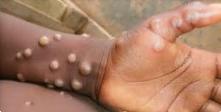 How MonkeyPox looks like